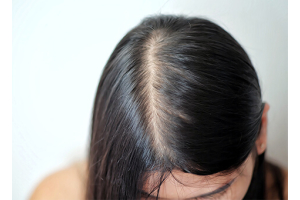 Female Hair Loss Self Diagnosis Chart