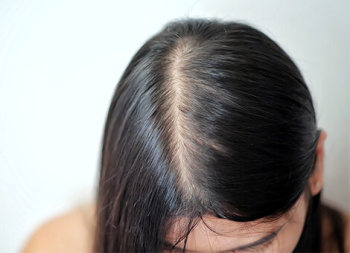 Female Hair Loss Self Diagnosis Chart